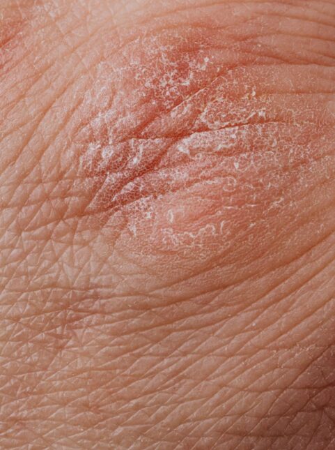 Detailed image highlighting dry, flaky skin texture for dermatological study.